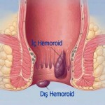 hemoroid basur resimleri 150x150 3 Günde Hemoroidinizden kesin olarak kurtulmanın yolu